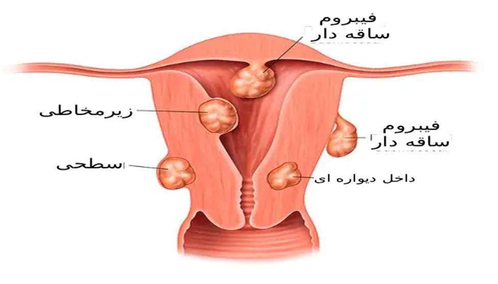 انواع فیبروم رحم