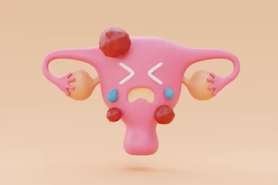 آندومتریوز و علائم آن