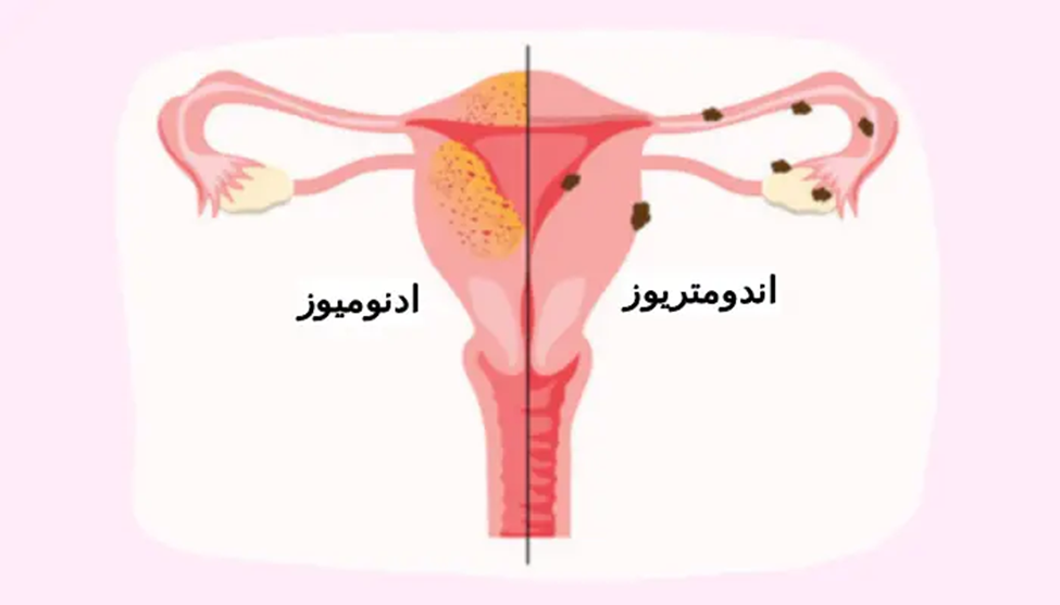 دلایل انجام هیسترکتومی