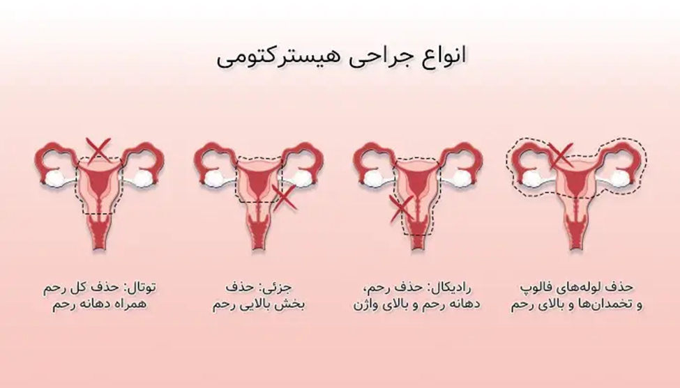انواع جراحی هیسترکتومی