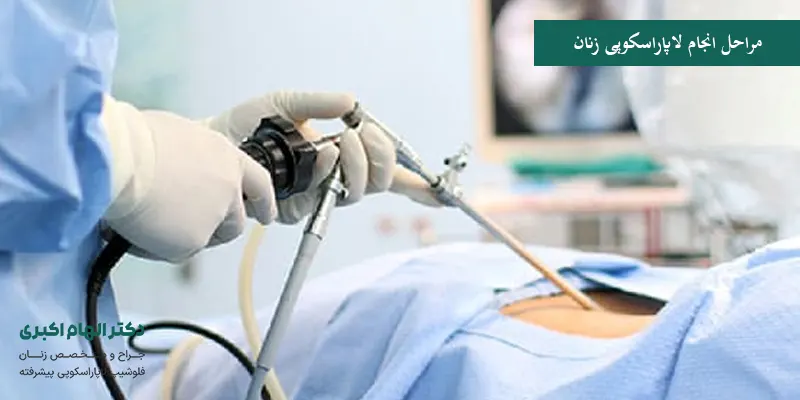 مراحل انجام لاپاراسکوپی زنان