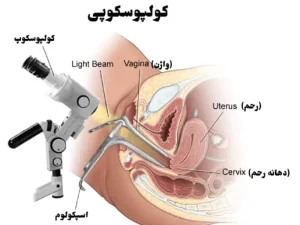 کولپوسکوپی چیست