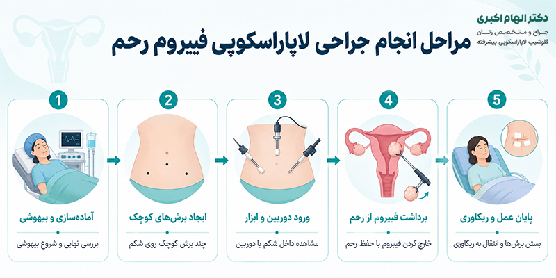 مراحل انجام جراحی لاپاراسکوپی فیبروم رحم