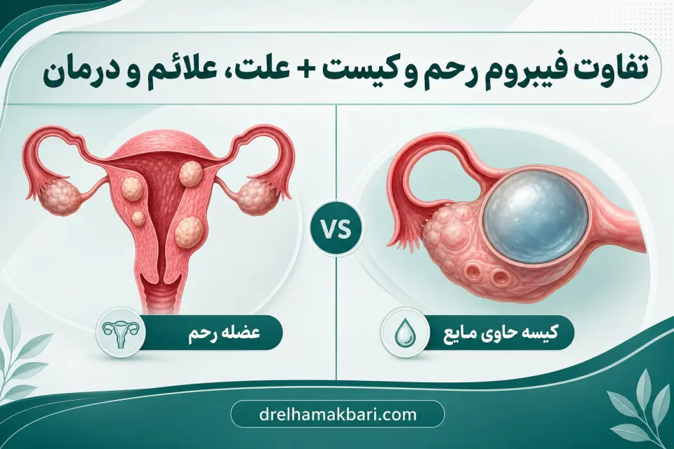 تفاوت فیبروم رحم و کیست + علت، علائم و درمان
