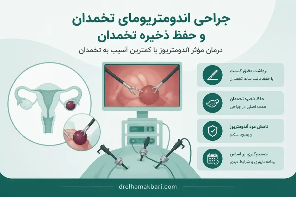 نمای توضیحی درباره جراحی اندومتریومای تخمدان و حفظ ذخیره تخمدان