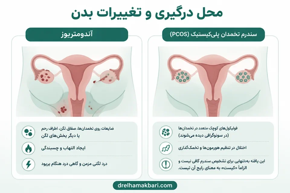 مقایسه محل درگیری آندومتریوز و تخمدان پلیکیستیک