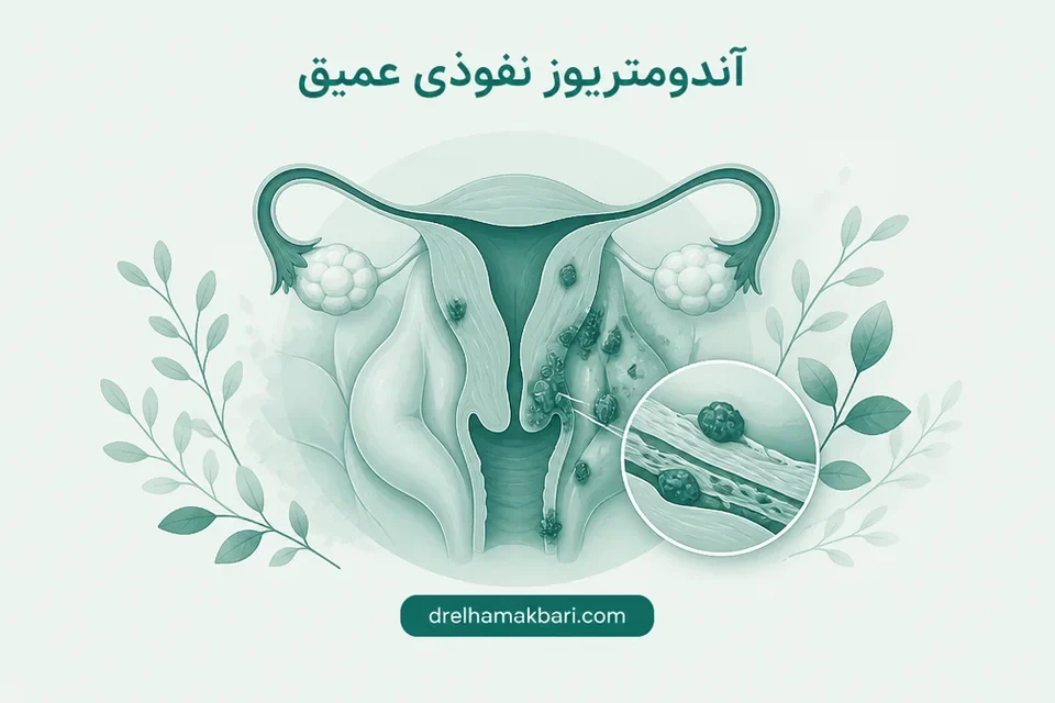 آندومتریوز نفوذی عمیق
