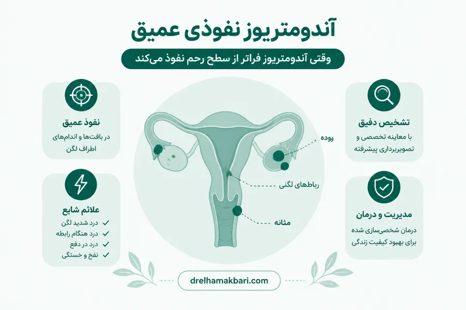 آندومتریوز نفوذی عمیق